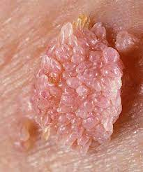 HPV - Condilom genital